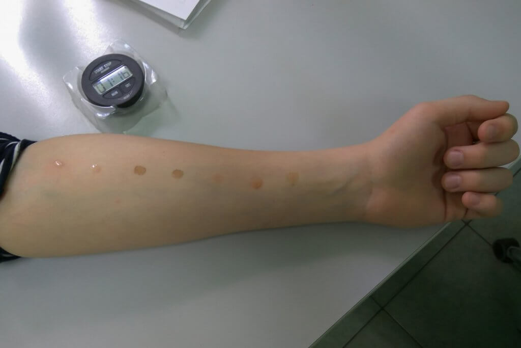 skin prick allergy test