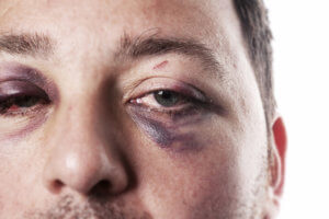 eye injury, male with black eye isolated on white. man after accident or fight with bruise