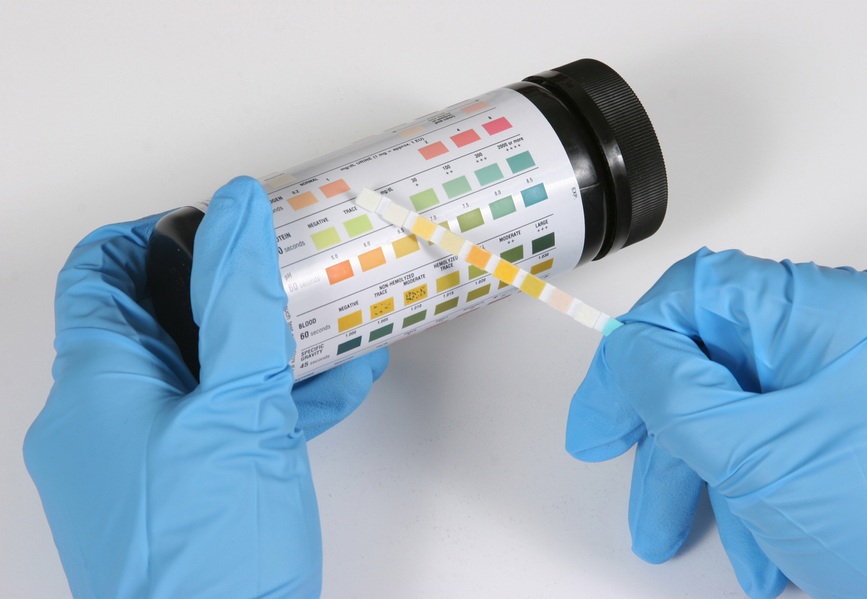 This is a urine dipstick being read by a medical professional.  This test would be used to determine the presence of several medical conditions.  Serial numbers removed from bottle.