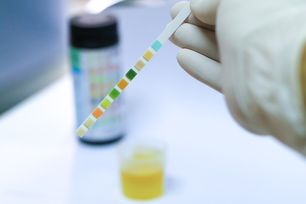 Reagent Strip for Urinalysis , Routine Urinalysis, check-up analysis in laboratory.